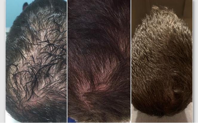 Before, during and after 3rd of the 3 recommended treatments